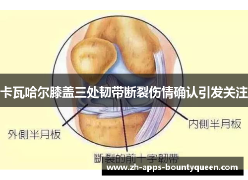 卡瓦哈尔膝盖三处韧带断裂伤情确认引发关注